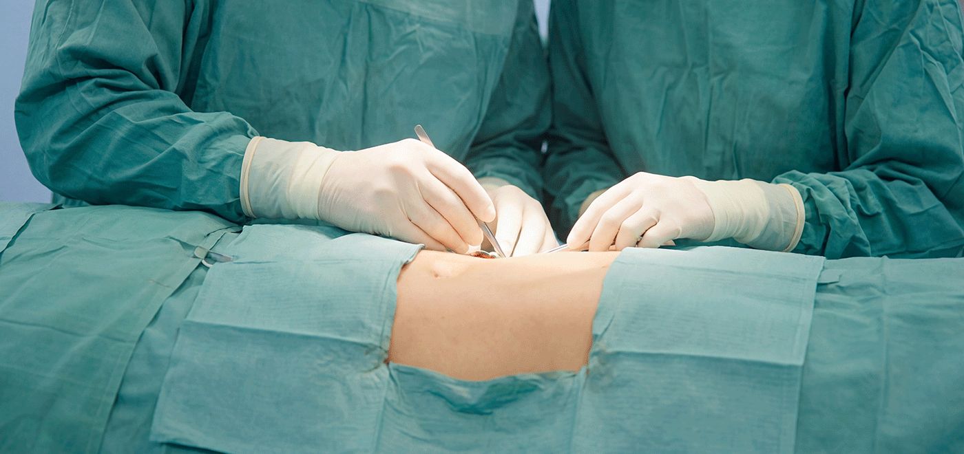 Two surgeons in sterile green scrubs performing a microsurgical harvest of a vascularised lymph node flap from the abdomen for a nodal transfer procedure.