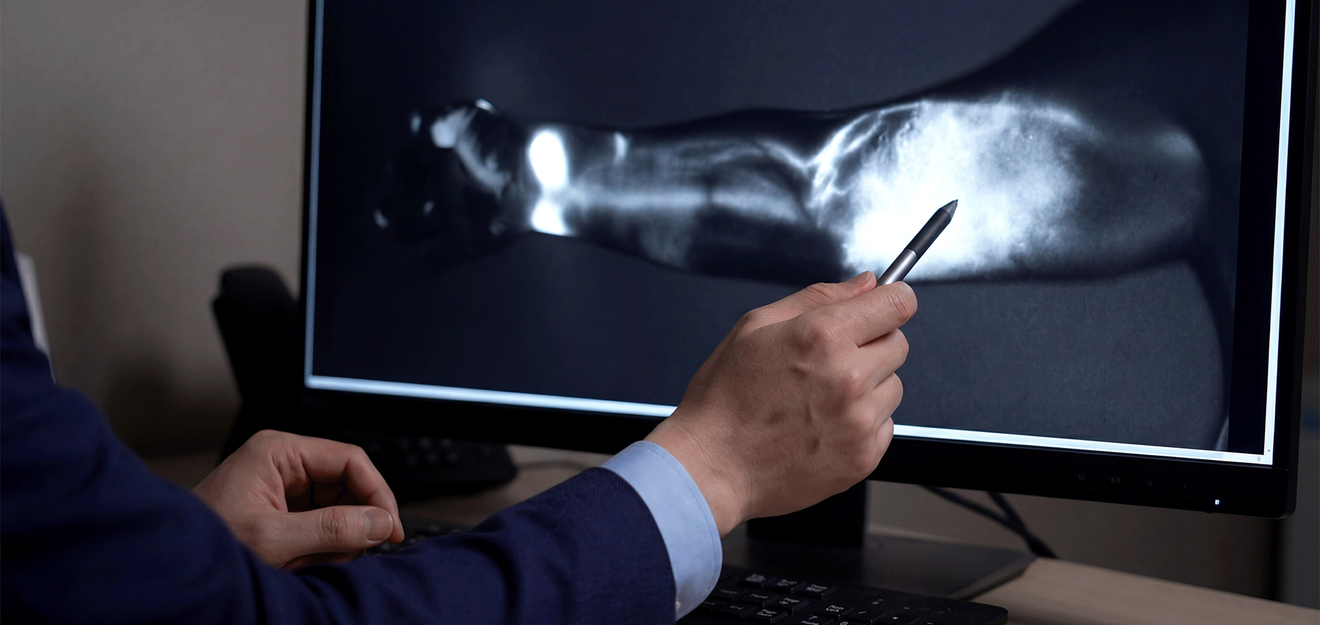 A consultant surgeon pointing to a high-resolution ICG lymphography scan on a clinical monitor, identifying dermal backflow patterns and functional collectors for pre-operative planning for lymphoedema surgery by lymphaticovenous anastomosis (LVA).