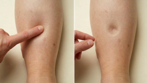 A demonstration of pitting edema test on a leg. The left side shows a finger pressing firmly into the swollen leg. The right panel shows a persistent, deep indentation or "pit" that remains in the tissue after the finger is removed.