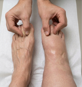 A top-down clinical photograph comparing a healthy foot and a lymphoedematous foot. On the healthy foot (left), it is possible to pinch and lift a thin, pliable fold of skin at the base of the second toe. On the affected foot (right), which shows significant swelling and loss of anatomical definition, the skin is too thick be lifted, demonstrating a positive Stemmer's sign.